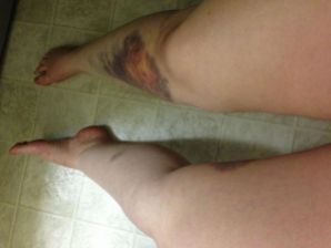 run over both legs bruises all oveer slowly rising