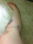 run over bruise now to ankle and around knee