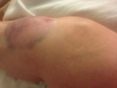 run over bruising spreading down leg